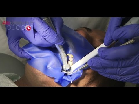 Soigner une carie sans dévitaliser la dent - Le Magazine de la santé